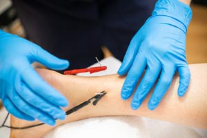 An electro-acupuncture treatment